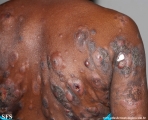 Cutaneous T-cell_lymphoma