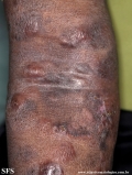 Cutaneous T-cell_lymphoma