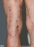 Cutaneous T-cell_lymphoma