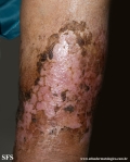 dermatosis neglecta