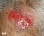 dermatosis neglecta