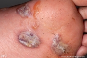 larva migrans
