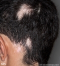 alopecia_areata_and_vitiligo