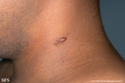 leprosy lepromatous