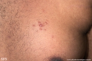 leprosy lepromatous
