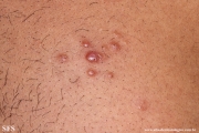 leprosy lepromatous