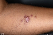 leprosy lepromatous