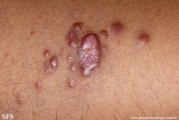 leprosy lepromatous
