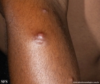 leprosy lepromatous