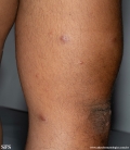 leprosy lepromatous