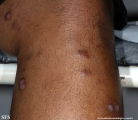 leprosy lepromatous