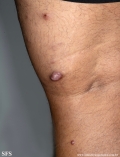 leprosy lepromatous