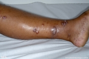 leprosy lepromatous