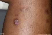 leprosy lepromatous