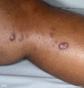 leprosy lepromatous