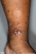 leprosy lepromatous