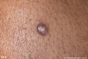 leprosy lepromatous