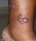 leprosy lepromatous
