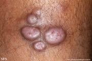 leprosy lepromatous