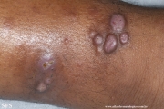 leprosy lepromatous