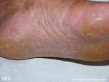 tinea_pedis_by_nigrospora_sp