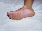 tinea_pedis_by_nigrospora_sp