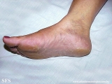 tinea_pedis_by_nigrospora_sp