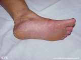 tinea_pedis_by_nigrospora_sp