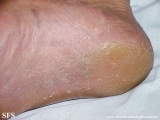 tinea_pedis_by_nigrospora_sp