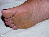 tinea_pedis_by_nigrospora_sp