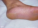 tinea_pedis_by_nigrospora_sp