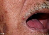 trichilemmoma-desmoplastic_trichilemmoma