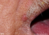 trichilemmoma-desmoplastic_trichilemmoma