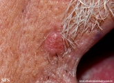 trichilemmoma-desmoplastic_trichilemmoma