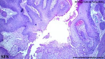 trichilemmoma-desmoplastic_trichilemmoma