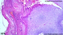 trichilemmoma-desmoplastic_trichilemmoma