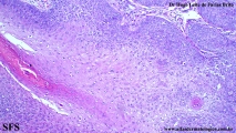 trichilemmoma-desmoplastic_trichilemmoma