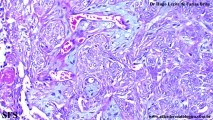 trichilemmoma-desmoplastic_trichilemmoma