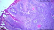 trichilemmoma-desmoplastic_trichilemmoma
