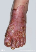 acrodermatitis enteropathica