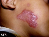 leprosy tuberculoid-nodular leprosy of childhood
