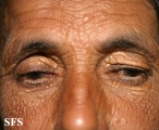 xanthelasma palpebrarum