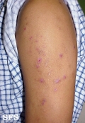 neurotic excoriations