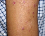 neurotic excoriations