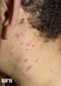 neurotic excoriations