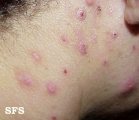 neurotic excoriations