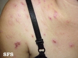 neurotic excoriations