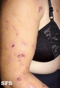 neurotic excoriations
