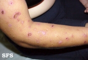 neurotic excoriations