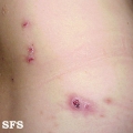 neurotic excoriations